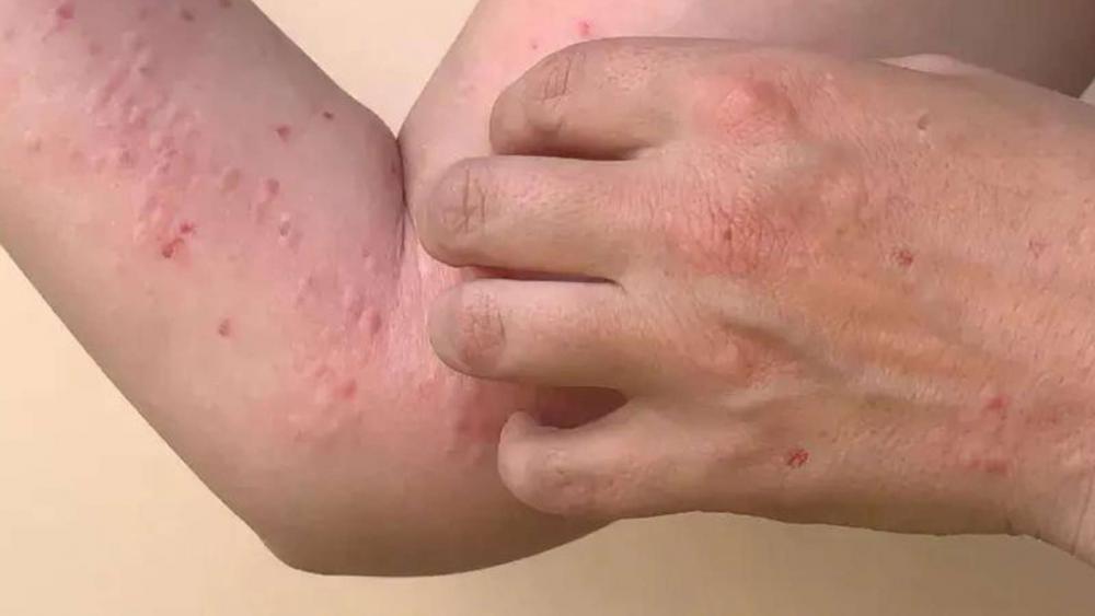 Entre Ríos mantiene el monitoreo de la situación epidemiológica por la Viruela del Mono